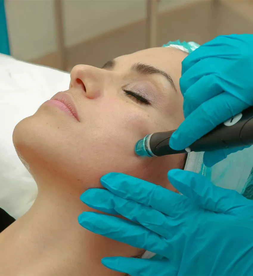 Especialista con guantes azules aplicando un dispositivo de microneedling en el rostro de una paciente